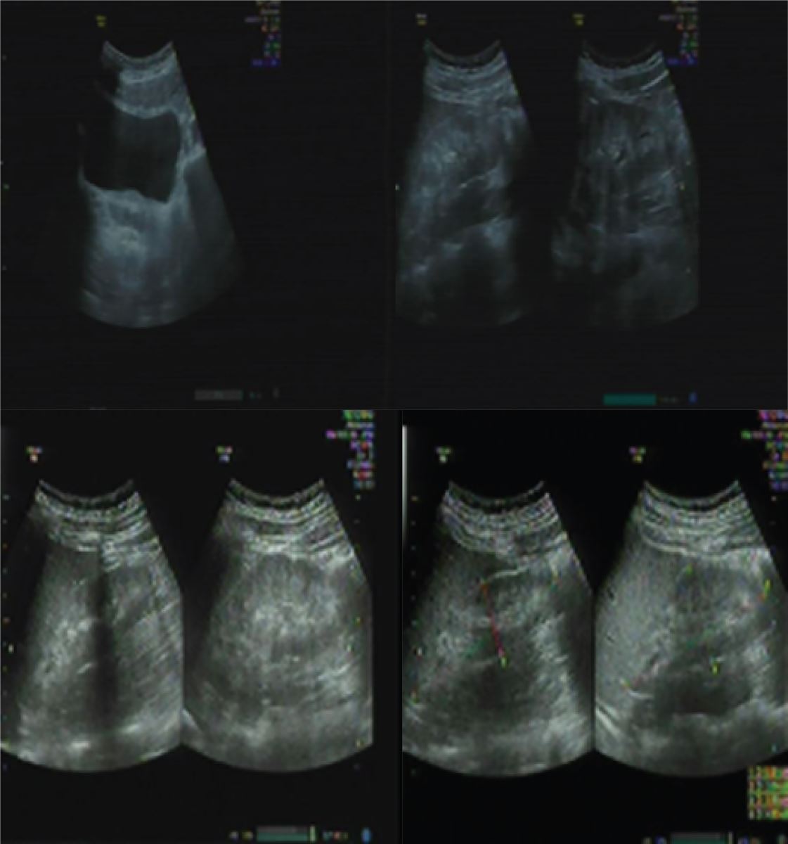 Hình ảnh siêu âm ổ bụng của bệnh nhân cho kết quả nhu mô 2 thận tăng âm, kém phân biệt tủy vỏ